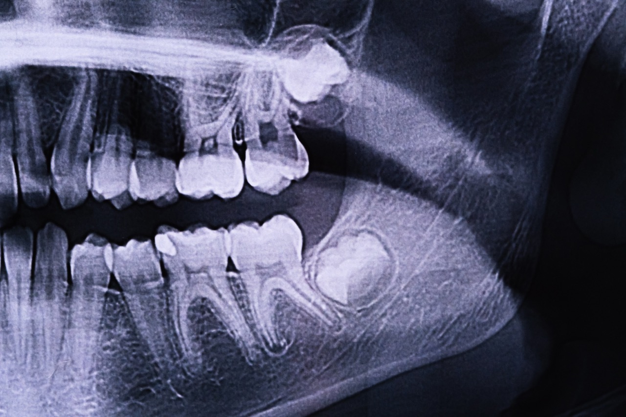 Bitewing X-ray of teeth
